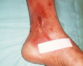 man venous ulcers fig1